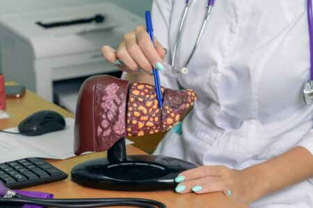Strata už piatich percent telesnej váhy dokáže odstrániť stukovatenie pečene, tvrdí hepatológ