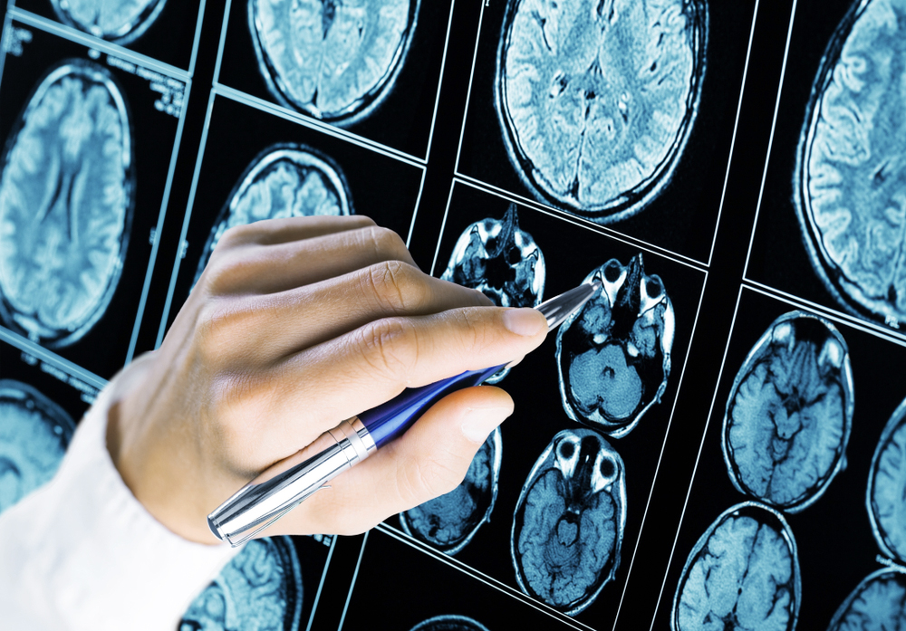 Zakázaný liek a Alzheimerova choroba? Vedci našli spojenie