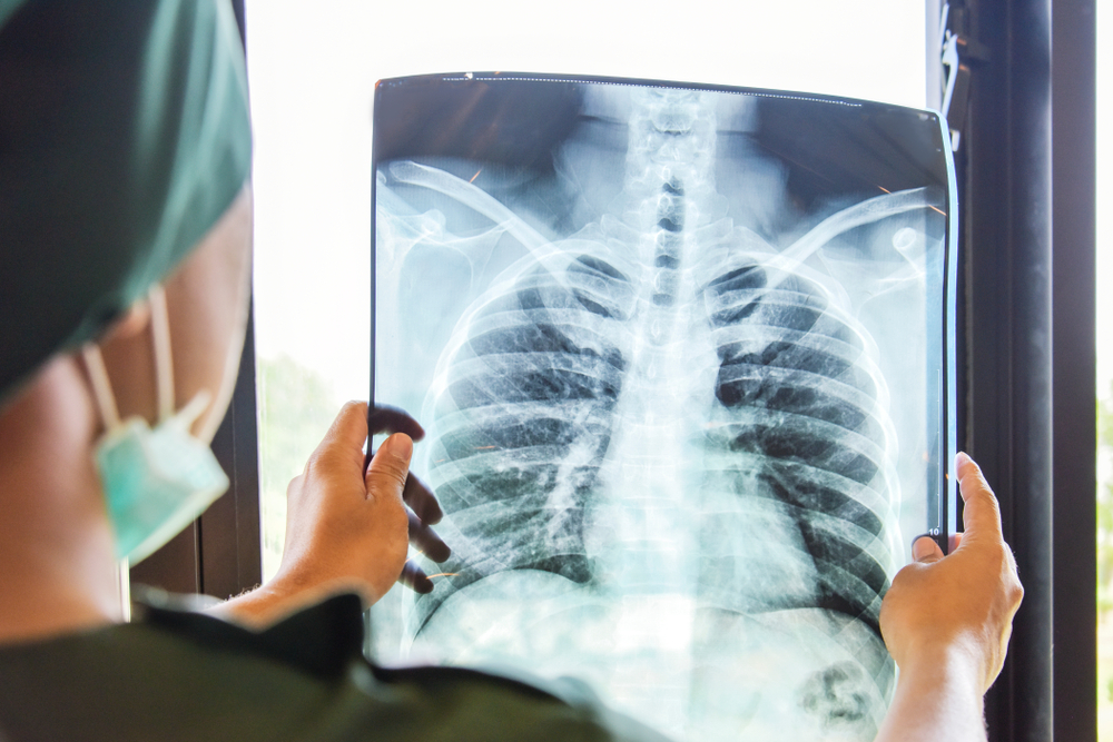 V Banskobystrickom kraji končia dve pneumologické ambulancie. Stovky pacientov ostanú bez pľúcnych lekárov