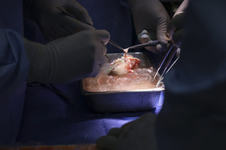 Pacient s transplantovanou prasacou obličkou mal mierne komplikácie. Už je však doma