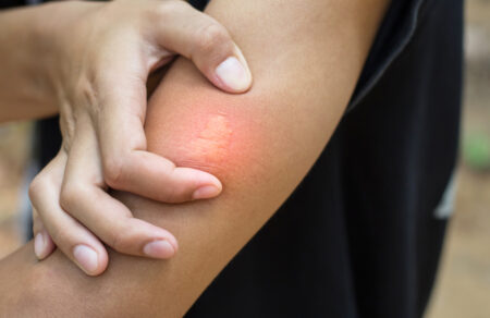 Pred život ohrozujúcim bodnutím hmyzom môže ochrániť imunoterapia