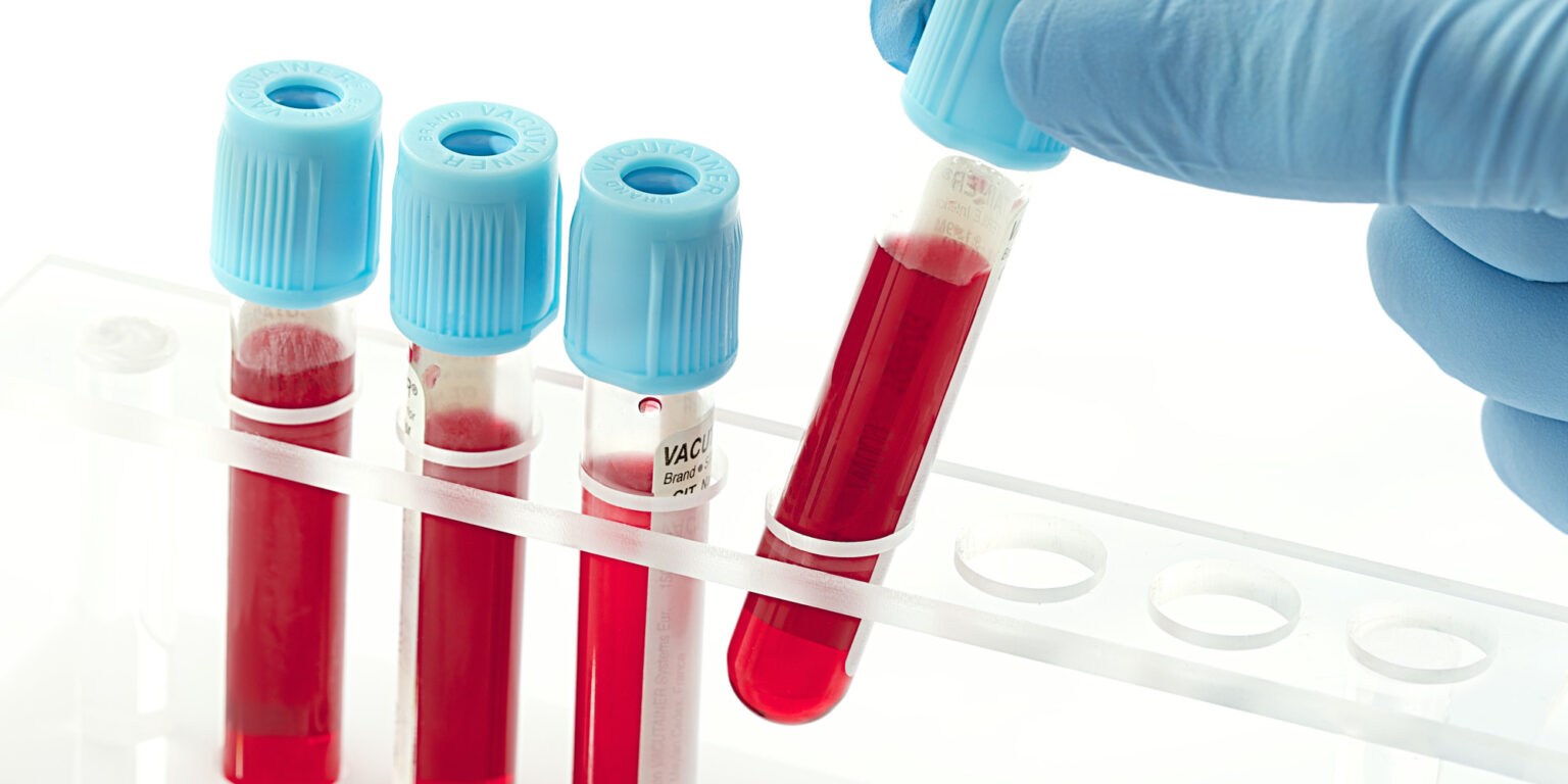 Bardejovská nemocnica otvorila novú hematologickú a transfúziologickú ambulanciu