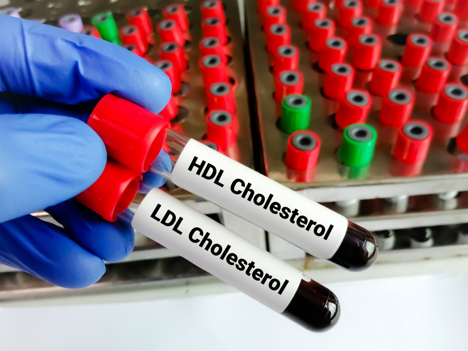Cholesterol trápi deväť z desiatich Slovákov, mýty o ňom stále pretrvávajú