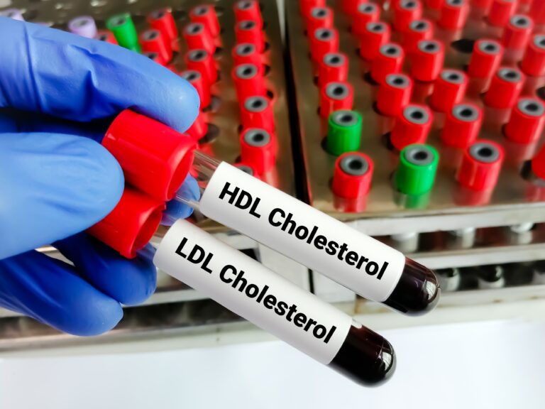 Cholesterol trápi deväť z desiatich Slovákov, mýty o ňom stále pretrvávajú