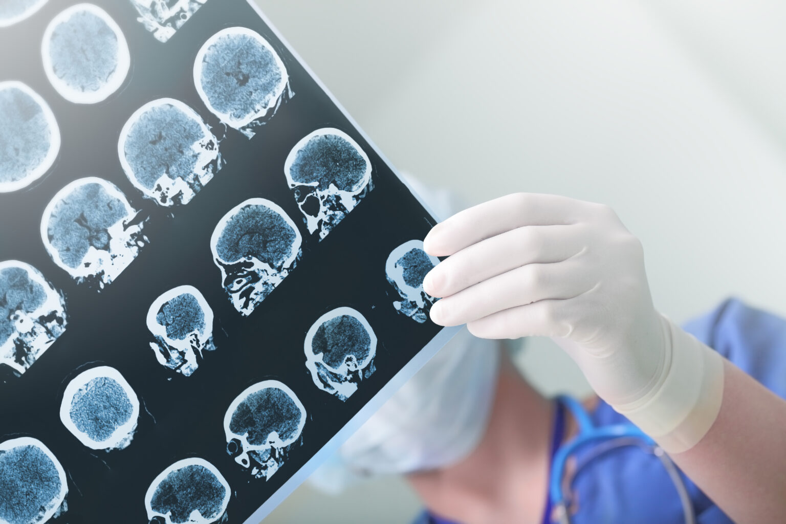 Pri Alzheimerovej chorobe je kľúčová včasná diagnostika a poradenstvo