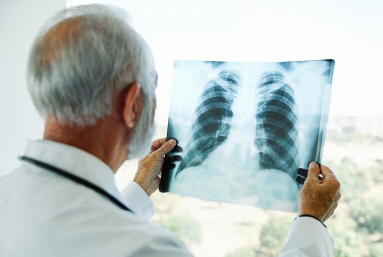Prečo pribúda nefajčiarov s rakovinou pľúc: Odborníci našli odpoveď