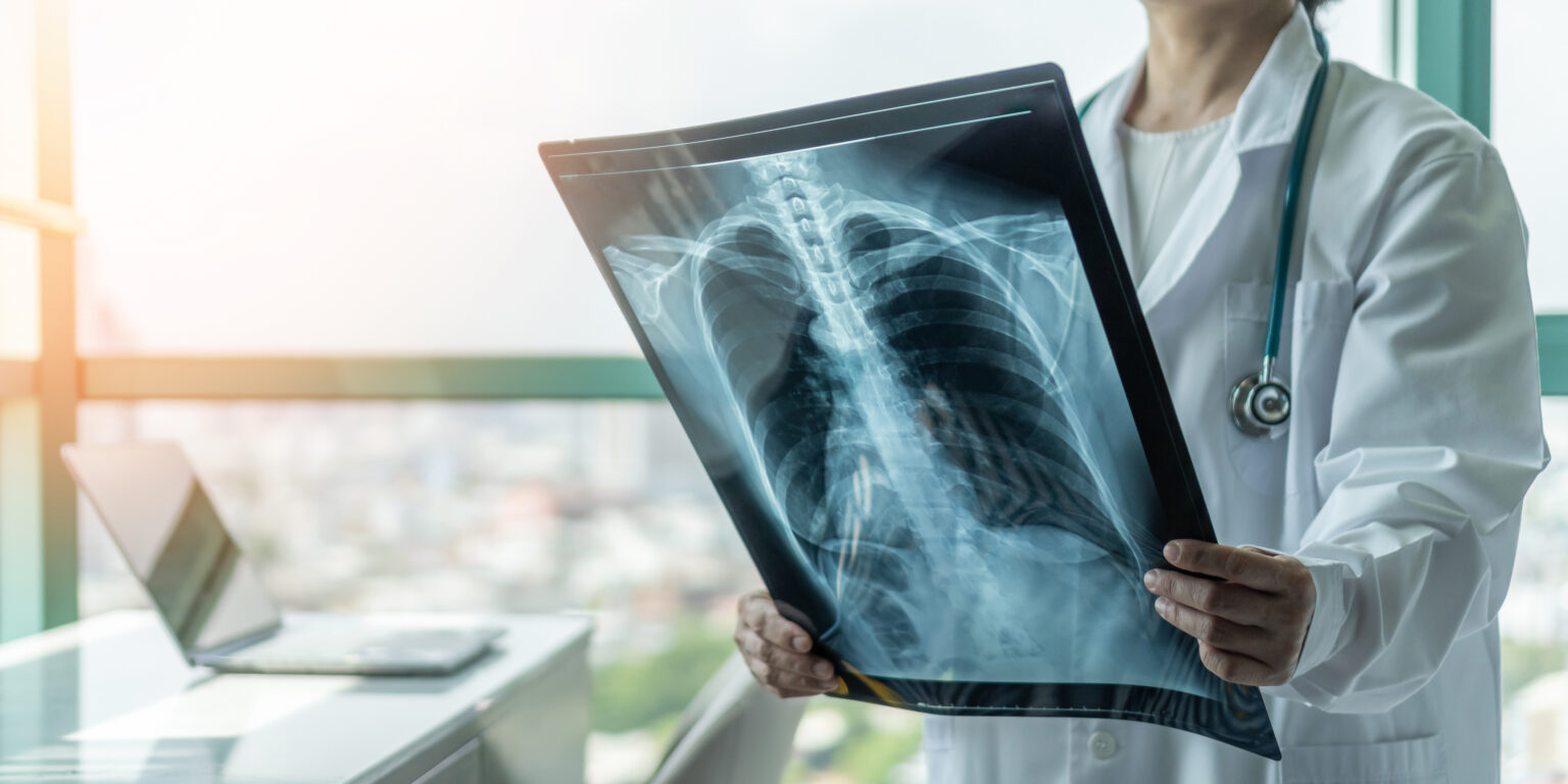 Pneumologička: Tuberkulóza na Slovensku ustupuje, zďaleka však nemáme vyhraté